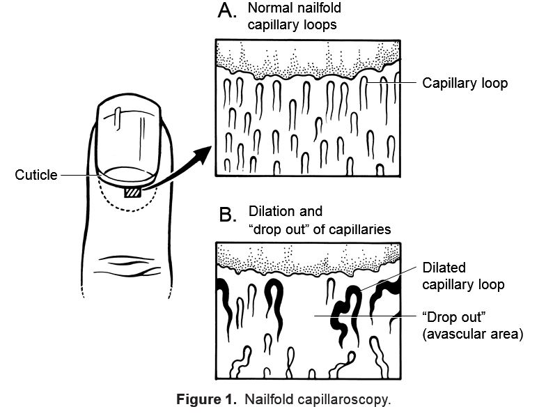 Elliptical broken line method for calculating capillary density in nailfold  capillaroscopy: Proposal and evaluation - ScienceDirect