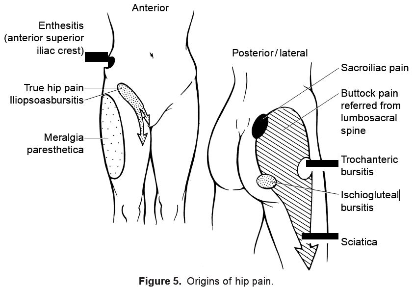 Hip Pain Location Diagram