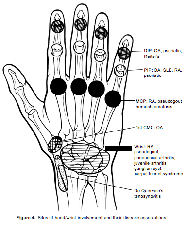 Sites of hand/wrist involvement and their disease associations.