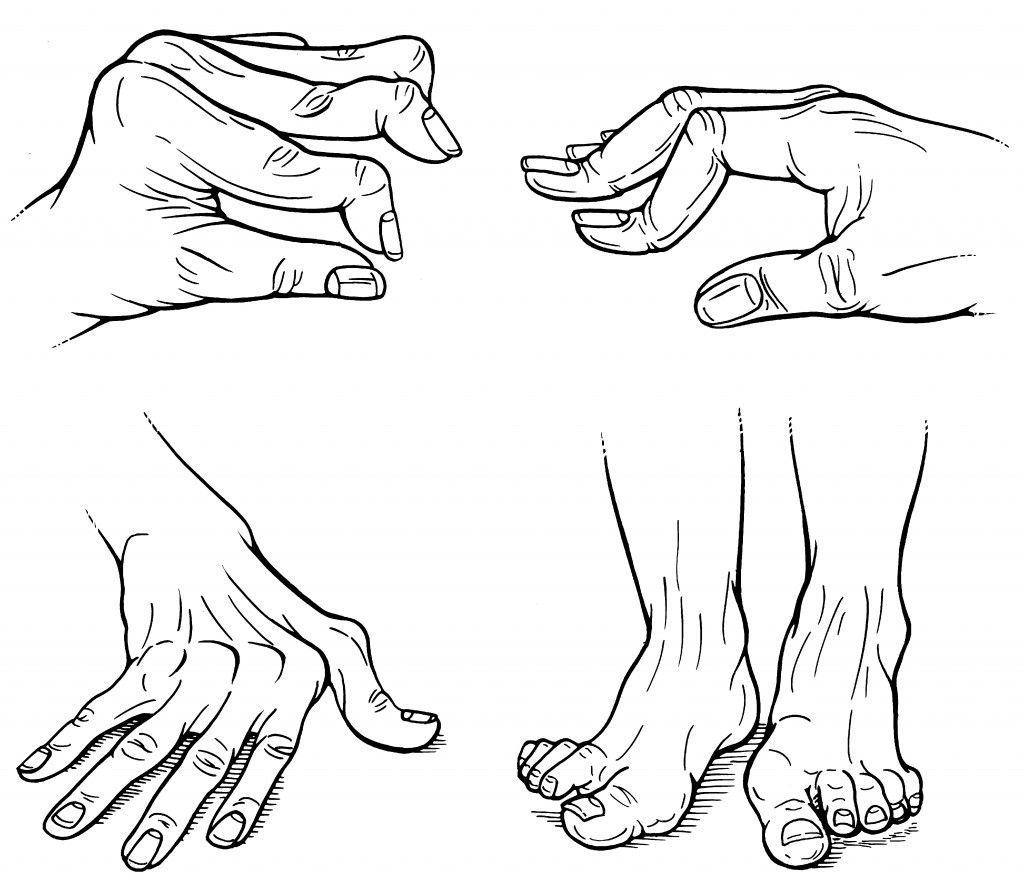 Figure.  Rheumatoid arthritis hand deformities