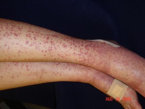 Lower Extremity Palpable Purpura